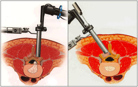 脊椎内視鏡下手術イメージ