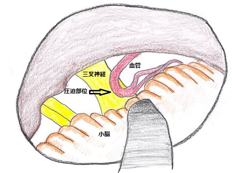 図１A　三叉神経痛の手術所見図　三叉神経に脳血管が圧迫している