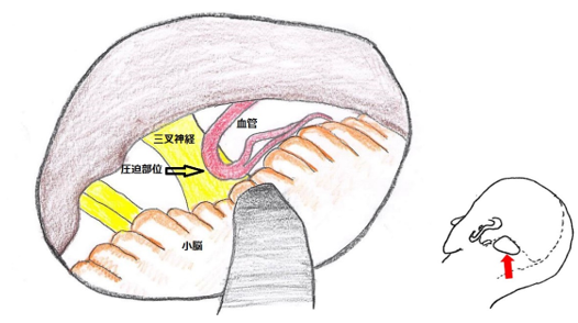 図1A 三叉神経痛の手術所見図 三叉神経に脳血管が圧迫している