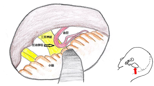 図１A　三叉神経痛の手術所見図　三叉神経に脳血管が圧迫している