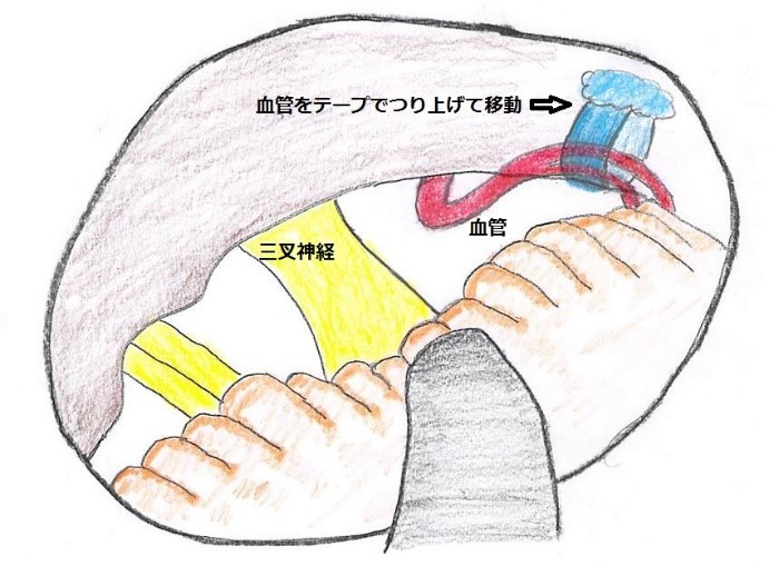 図２A　三叉神経痛の手術所見図　血管をテープでつり上げて移動し神経に血管が当たらないようにした