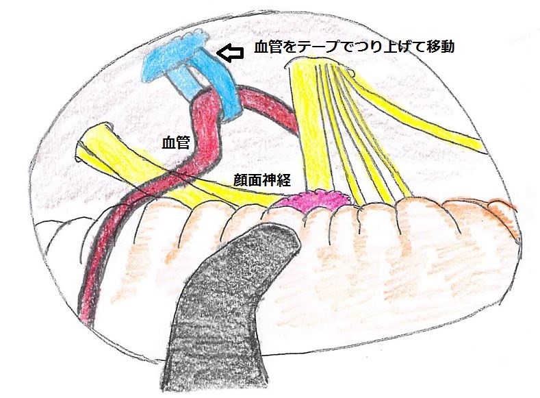 図２B　片側顔面けいれんの手術所見図　血管をテープでつり上げて移動し神経に血管が当たらないようにした