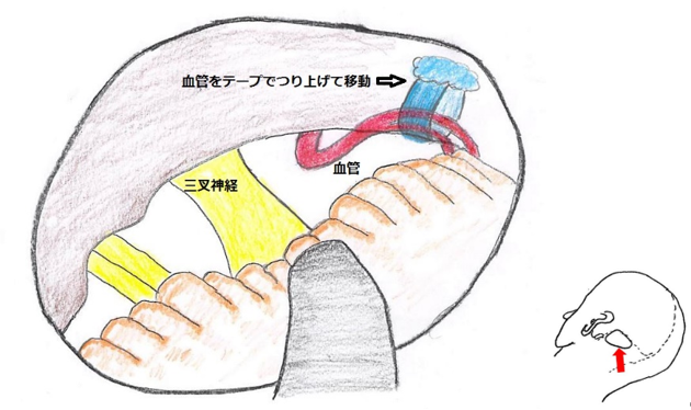 図２A　三叉神経痛の手術所見図　血管をテープでつり上げて移動し神経に血管が当たらないようにした