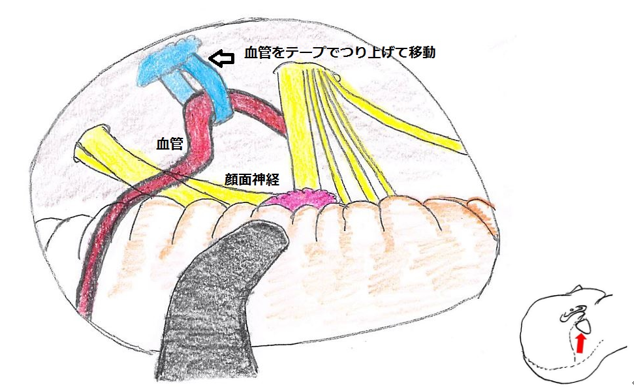 図２B　片側顔面けいれんの手術図　血管をテープでつり上げて移動し、神経に血管が当たらないようにした