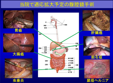 当院で適応拡大予定の腹腔鏡手術