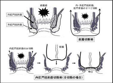 内肛門括約筋切除術（全切除の場合）