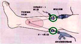 内視鏡下筋膜下穿通枝切離術